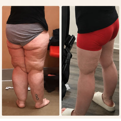 Avalia® 3D Relief Leggings - For Women With Lipedema, Swollen & Heavy Legs